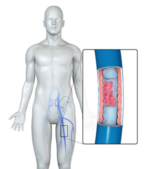 https://www.chinovascularsurgerycenter.com/3d-images/deep-vein-thrombosis.jpg